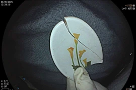 Cụ ông nuốt cả mảnh thìa nhựa 3 cm trong vùng mũi – hầu họng