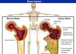 Dấu hiệu cảnh báo xương có vấn đề, cẩn thận ung thư