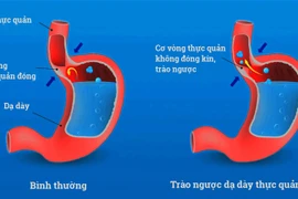 Bác sĩ mách cách tránh trào ngược dạ dày - thực quản trong và sau Tết