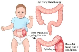 Người đàn ông 46 tuổi “chửa phân” do phình đại tràng bẩm sinh
