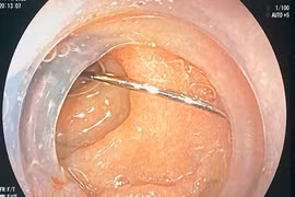 16 tuổi nhập viện cấp cứu do vô tình nuốt phải kim khâu