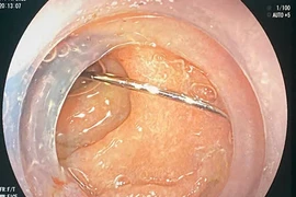 16 tuổi nhập viện cấp cứu do vô tình nuốt phải kim khâu