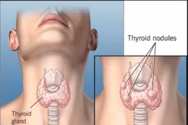 U tuyến giáp lành tính để lâu có sợ chuyển thành ung thư?