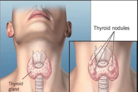 U tuyến giáp lành tính để lâu có sợ chuyển thành ung thư?