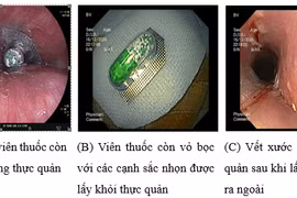 Thận trọng khi uống thuốc để tránh nhập viện cấp cứu vì nuốt cả vỏ thuốc