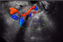 Cuộc chạy đua cấp cứu giành lại sự sống cho sản phụ mạch máu tiền đạo
