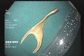 Nhiều người bị dị vật xương lớn mắc tại thực quản, cách tránh trong dịp Tết