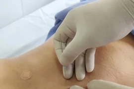 Cấy chỉ “cứu” chân tê bì do thoái hóa cột sống chèn ép thần kinh