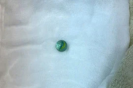 Nội soi gắp viên bi trong dạ dày bé trai 5 tuổi