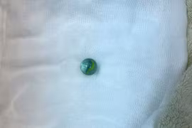 Nội soi gắp viên bi trong dạ dày bé trai 5 tuổi