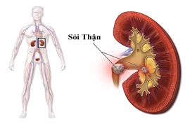 Địa chỉ vàng: Các bệnh viện điều trị sỏi thận tốt tại Hà Nội
