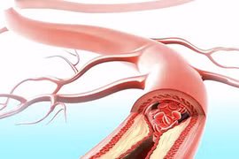 Công thức "vàng" làm sạch mạch máu hiệu quả