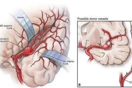 Phẫu thuật phức tạp cứu bệnh nhân phình mạch não lớn, cách gì phát hiện sớm?