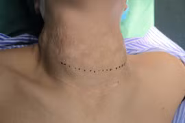 Cổ chẳng chịt sẹo ... vì đắp lá, uống thuốc nam