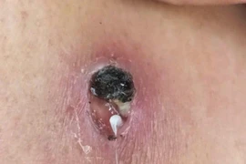 Giun rồng 1 mét chui ra từ người đàn ông 44 tuổi, cách phòng bệnh