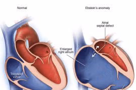 17 tuổi phát hiện tim giống cánh buồm