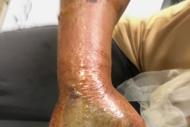 Hoại tử nghiêm trọng bàn tay vì đắp thuốc nam khi bị rắn hổ mang cắn