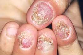 Cẩn thận bệnh nấm da trời nồm