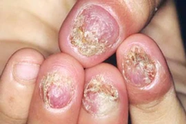 Cẩn thận bệnh nấm da trời nồm