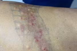 Tiêm Botulinum toxin - Giải pháp mới trong điều trị đau sau zona