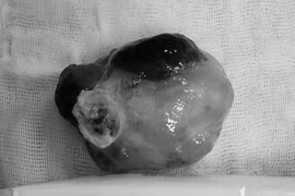 "Thoát tử" nhờ phát hiện khối u lớn trong tim khi tầm soát sức khỏe