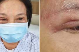 Múc bỏ cả con mắt do zona thần kinh tấn công, cách gì phòng ngừa