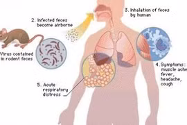 Sốt do nhiễm virus ho ra máu tại Nga: Đâu phải virus nào cũng làm được!
