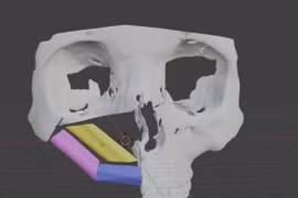 Công nghệ in 3D điều trị ung thư xương hàm mặt