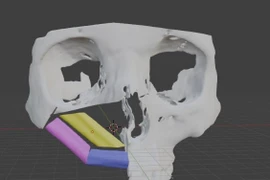 Công nghệ in 3D điều trị ung thư xương hàm mặt