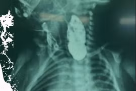  Nội soi tiên tiến cứu sống bé sơ sinh nặng 2,6 kg teo thực quản