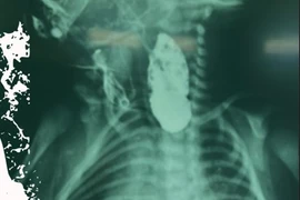  Nội soi tiên tiến cứu sống bé sơ sinh nặng 2,6 kg teo thực quản