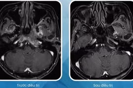 Cụ bà 90 tuổi vượt qua ung thư vòm họng nhờ xạ trị hiện đại