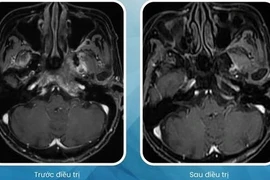Cụ bà 90 tuổi vượt qua ung thư vòm họng nhờ xạ trị hiện đại