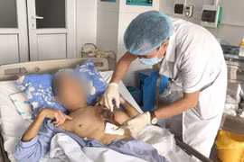 Mắc nấm hiếm gặp, người đàn ông bị hoại tử vùng ngực phải mổ 3 lần