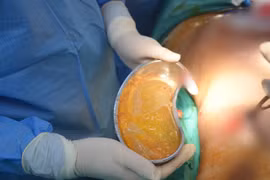 Hy hữu: Đang mang thai lần 3, người phụ nữ bị vỡ túi nâng ngực