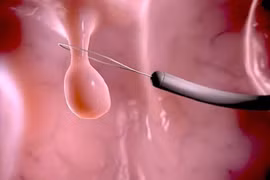 Khi nào cần cắt polyp dạ dày để tránh ung thư?