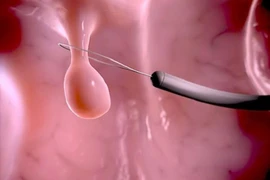 Khi nào cần cắt polyp dạ dày để tránh ung thư?