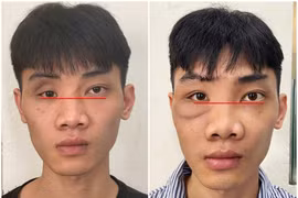 Tạo hình thành ổ mắt bằng công nghệ titan chữa mắt biến dạng sau tai nạn