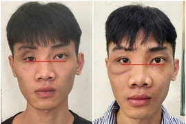 Tạo hình thành ổ mắt bằng công nghệ titan chữa mắt biến dạng sau tai nạn