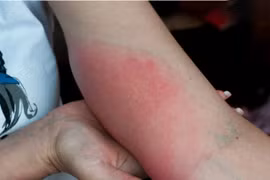 Đầu hè nhiều người đã bị sốc phản vệ do ong đốt, xử lý thế nào?