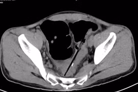 hủng ruột vì hội chứng thích ăn đồ vật