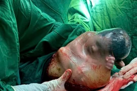 Em bé đầu năm sinh bọc điều với tỷ lệ hy hữu 1/80.000 ca