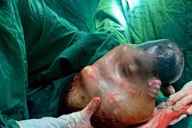 Em bé đầu năm sinh bọc điều với tỷ lệ hy hữu 1/80.000 ca