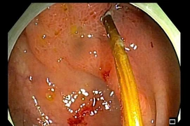 Hy hữu: Chiếc tăm xuyên thủng đại tràng cụ ông 71 tuổi chỉ vì thói quen