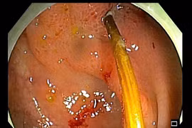 Hy hữu: Chiếc tăm xuyên thủng đại tràng cụ ông 71 tuổi chỉ vì thói quen