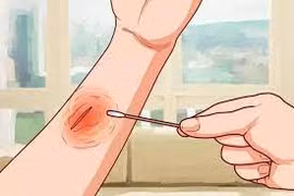 Cách chăm sóc vết thương tại nhà để tránh hoại tử 