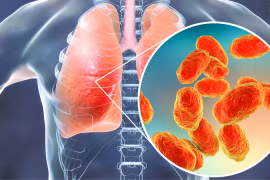  Virus Mycoplasma gây viêm phổi - Ảnh minh họa