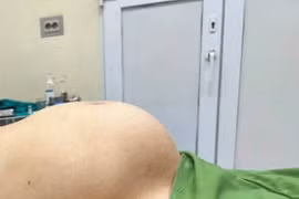 Người phụ nữ 65 tuổi mang khối u “khủng” như mang thai 8 tháng