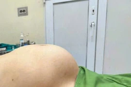 Người phụ nữ 65 tuổi mang khối u “khủng” như mang thai 8 tháng