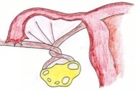 Bé 13 tuổi bị xoắn 7 vòng vòi buồng trứng phải